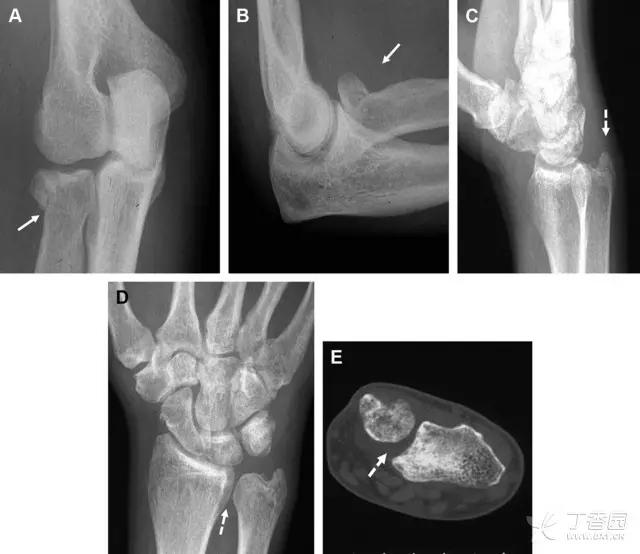 特殊骨折类型,特殊骨折体征