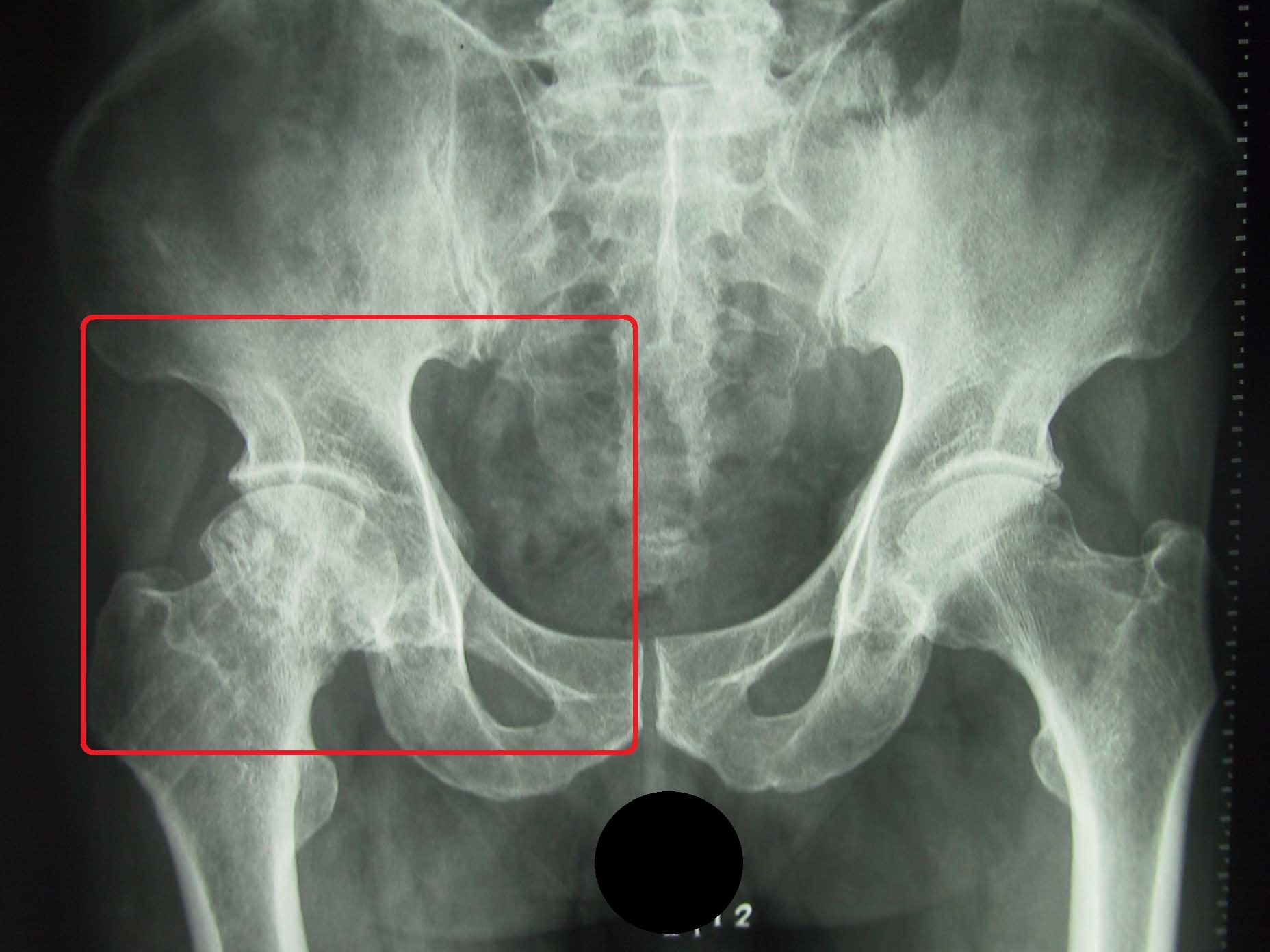 髋关节发育不良有什么拯救的方法,狗狗髋关节发育不良吃什么药