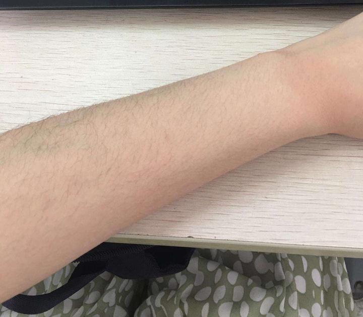 用了凡士林长毛的原因,使用凡士林皮肤变黑怎么办