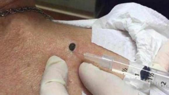 女人背后长了好多红色的痣,女子背上长的老黑痣最近痛痒