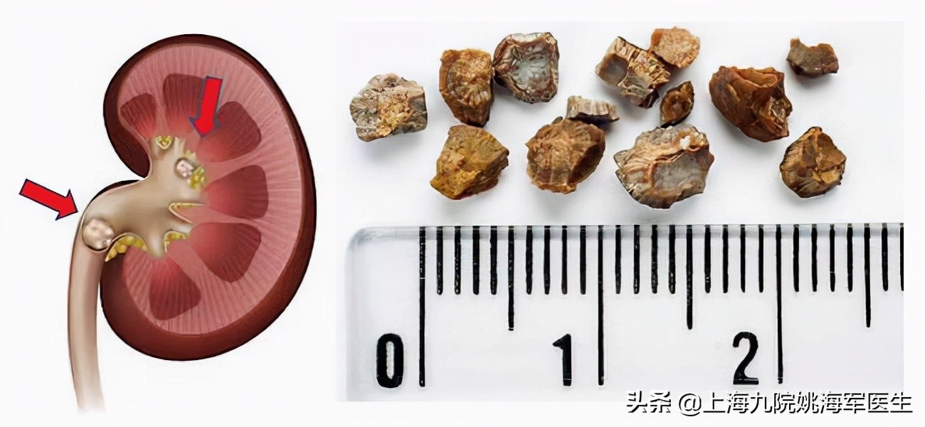 肾结晶和肾结石有区别吗,肾结晶和肾结石有什么不同