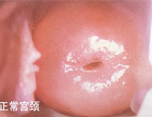 宫颈炎到底要不要治疗？