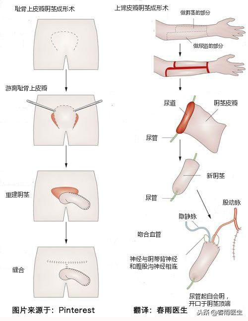 女变男手术时的“那活儿”是怎么无中生有的?
