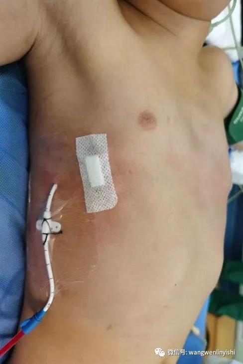 wenlin手术,wenlin手术怎么样