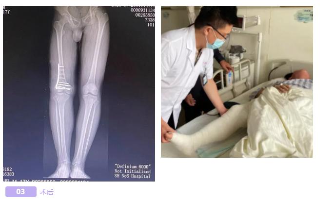 骨盆倾斜导致长短腿严重会怎样,长短腿骨盆倾斜