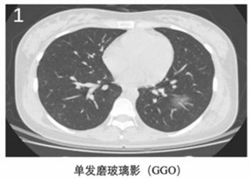 新冠肺炎胸片影像学表现有哪些,新冠肺炎患者轻微症状肺部ct表现