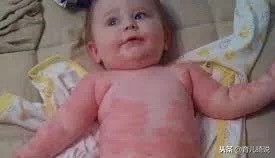 不要以为*麻疹荨**是大人的专利,岂不知小宝宝也会得,比大人更难治