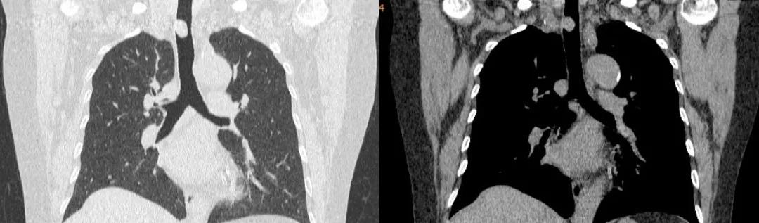 儿童90%为良性,成人却不到10%?患者气短3年,胸部CT提示的气管肿物意味着什么?气管镜有何发现?
