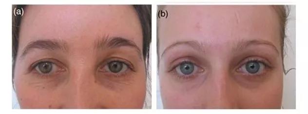 黑眼圈只是熬夜,熬夜狠了怎么拯救黑眼圈