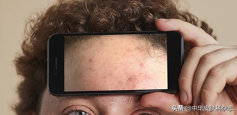 战痘全攻略,战痘全攻略详解