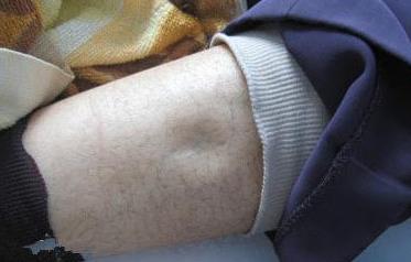 吃盐太多对肾有损坏吗,为什么吃盐多引起血压升高