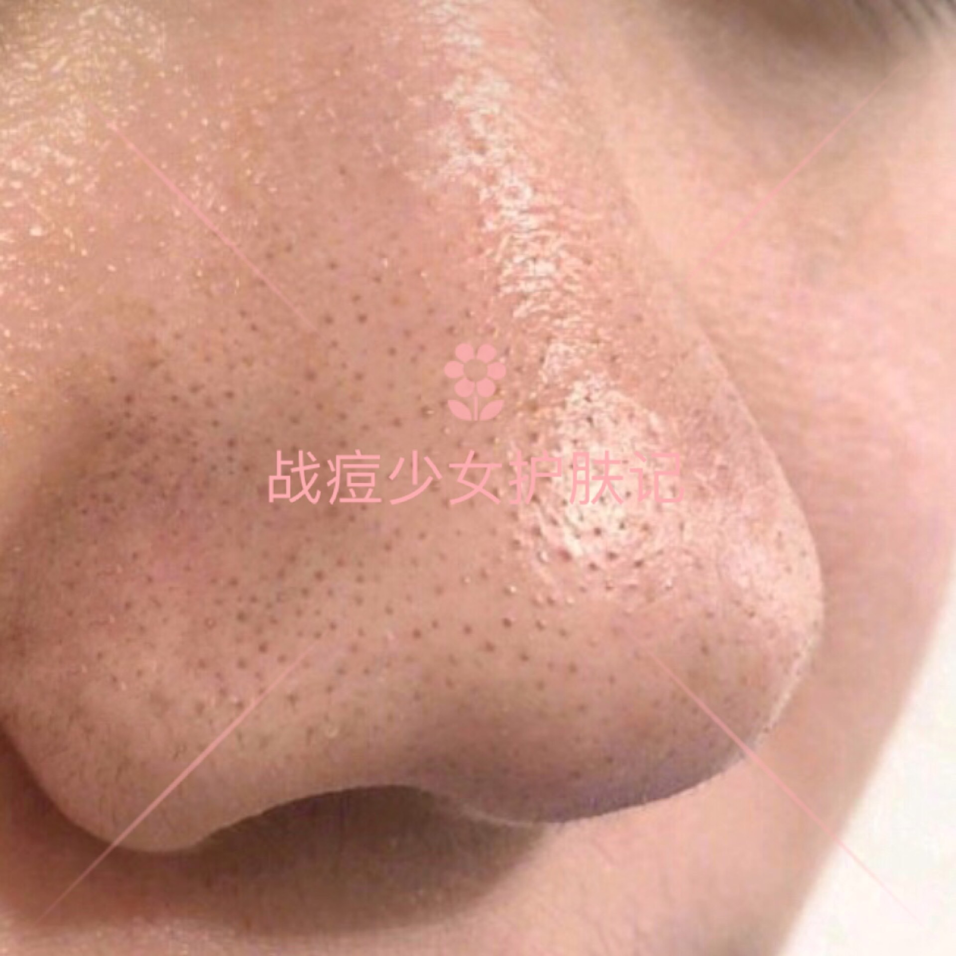 四招解决痘痘及痘痘的成因,痘痘不同原因类型及处理方法