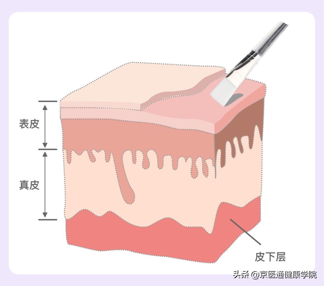 “毛孔粗大”粗的并不是“毛孔”,它是瘢痕呀！三种方法有效解决
