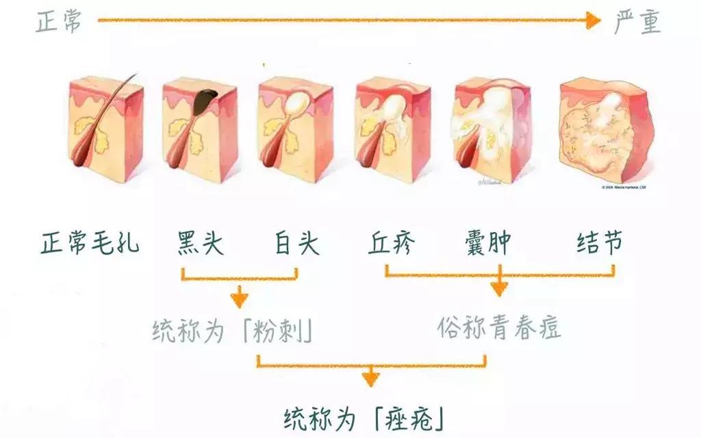 用芦荟胶去除粉刺,芦荟胶真的可以去黑头吗
