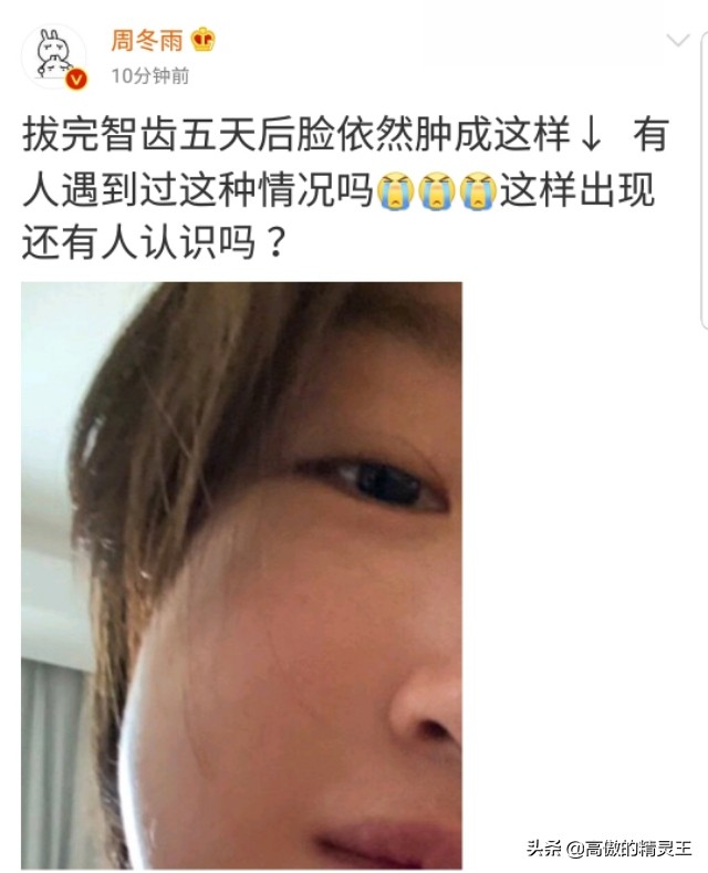 周冬雨拔智齿，五天后脸仍然肿成包子，评论区一片笑声