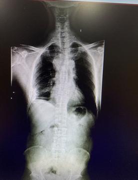 长期不良姿势脊柱侧弯,坐姿不良导致脊柱变形图