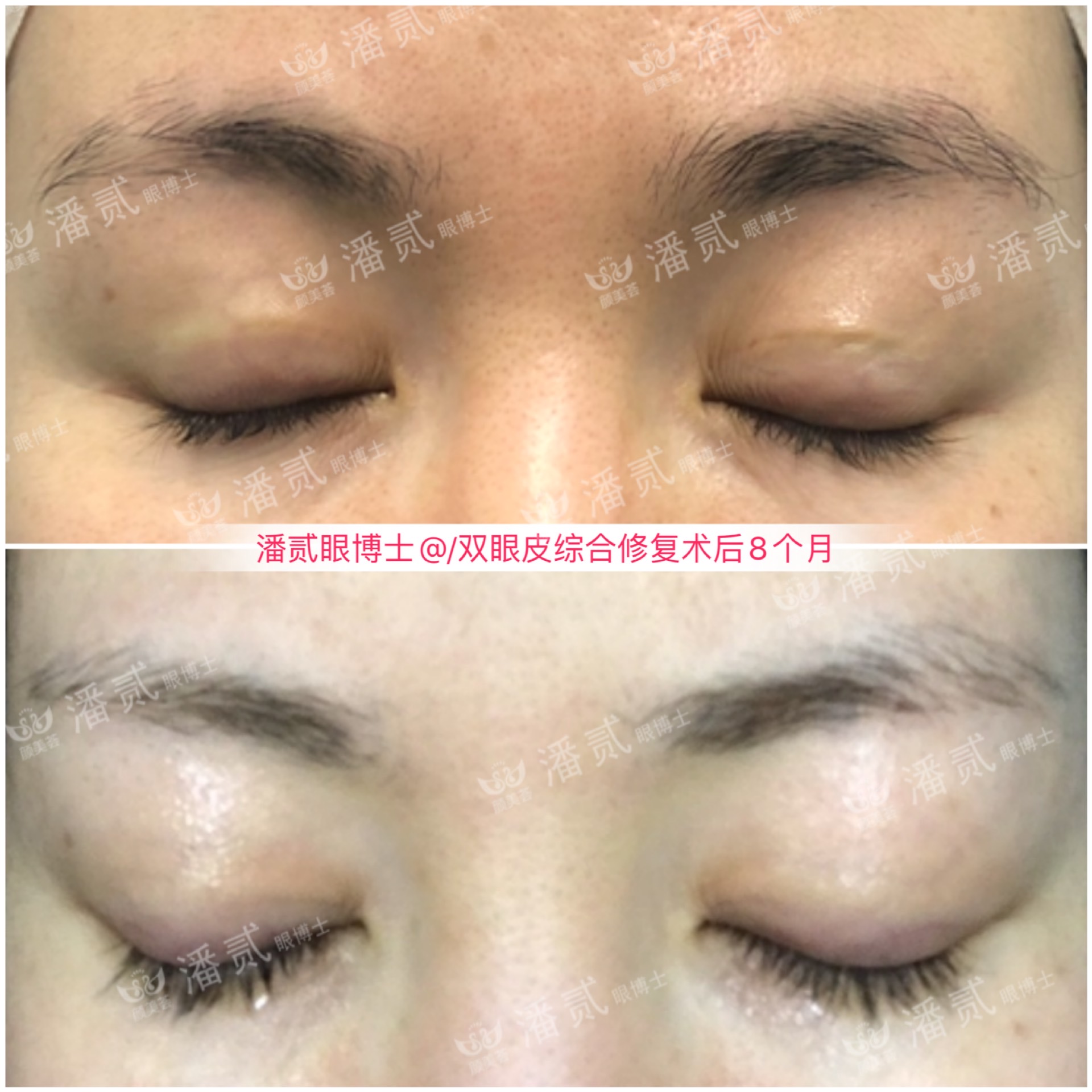 广州双眼皮修复内双,广州双眼皮修复可以只修眼尾吗