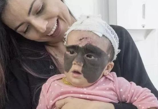 胎记女孩一夜爆红,胎记女孩手术前后对比