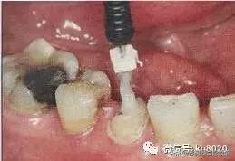 纤维桩的优点和缺点,看完这篇文章就明白了