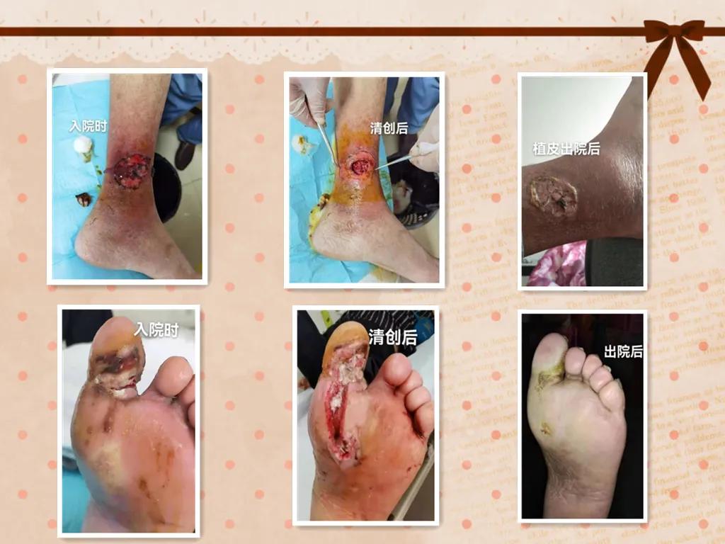 糖尿病足多学科诊治中心,糖尿病足多学科会诊