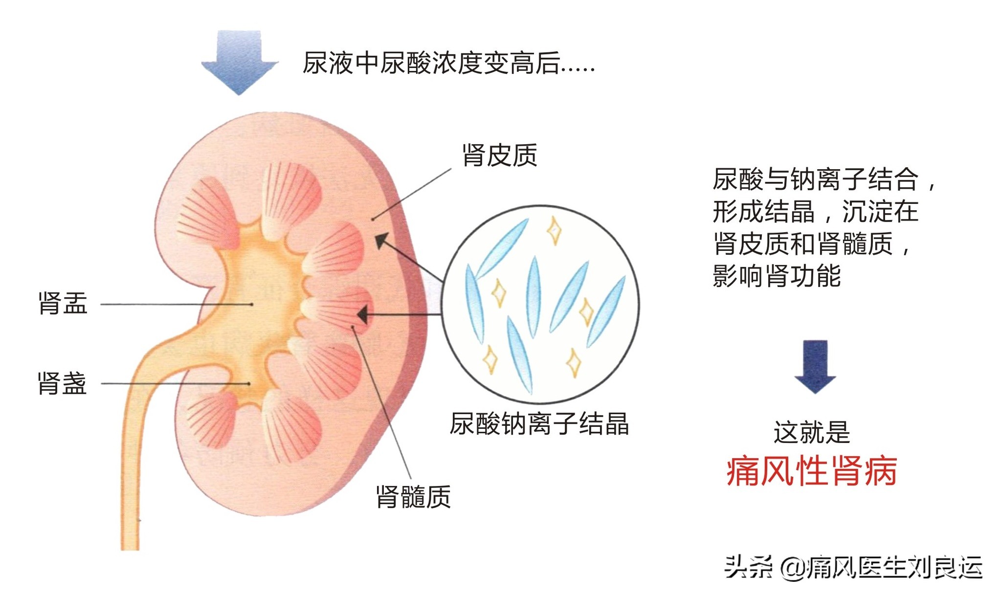 高尿酸没有症状到底要不要吃药,尿酸偏高怎么让尿酸下去