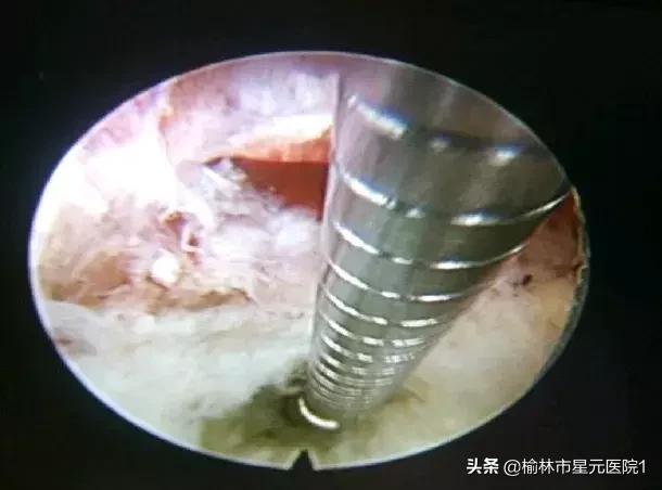 榆林市中医院治腰椎间盘突出症,榆林市治腰椎椎间盘突出