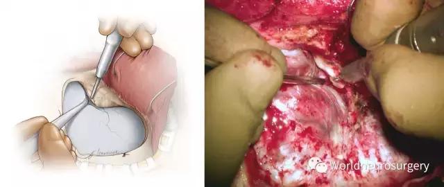 翼点入路的开颅要点,翼点开颅详解图