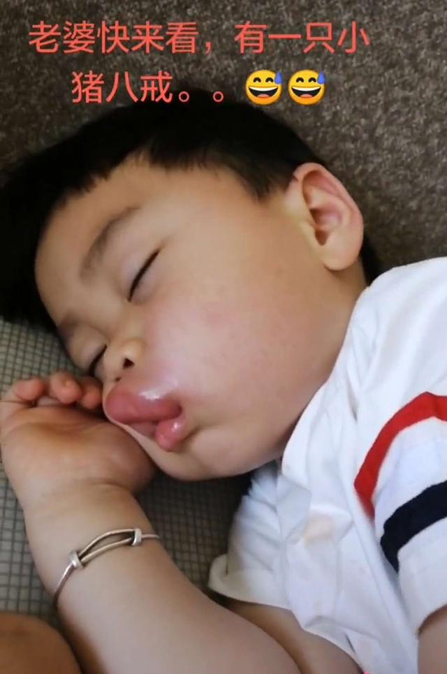 男童被蚊子咬后变成香肠嘴,小孩嘴巴被蚊子亲成香肠怎么办