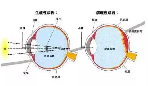 眼前一直有蚊子是什么病,眼前总有蚊子飞怎么治呀