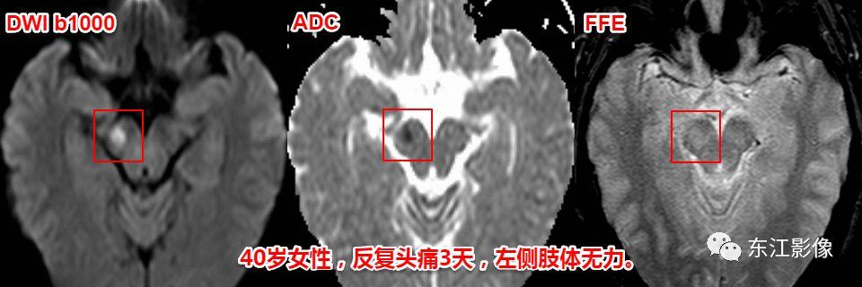 头颅mri扫描影像哪里找,头颅影像mra详细解说