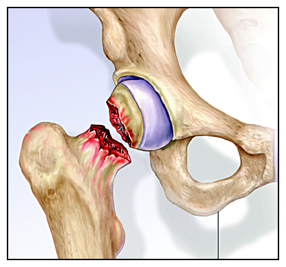 29岁右股骨颈骨折恢复最佳的方法,82老人股骨头摔骨折了该怎样治疗