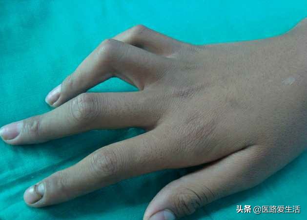 治疗神经损伤的膏药,治疗神经损伤的药