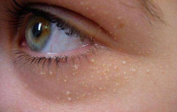 眼周脂肪粒要做什么医美,眼周围的脂肪粒适合用的护肤品