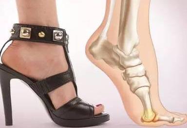 拇外翻克星,拇趾外翻畸形