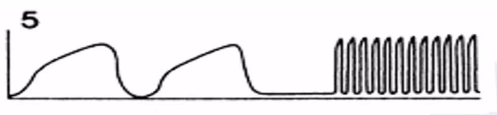 李娟教授：呼气末二氧化碳分压监测的临床应用