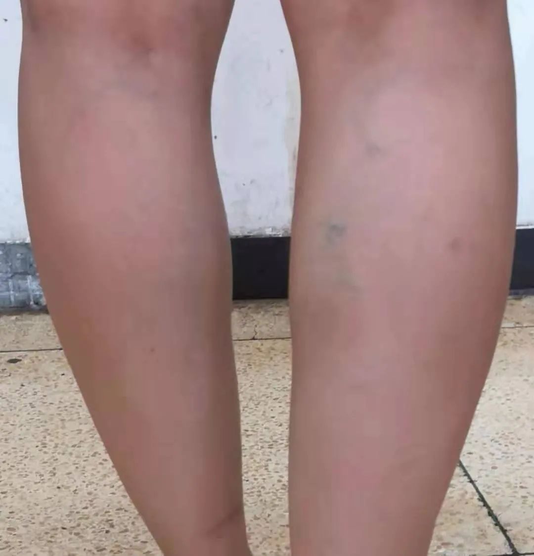 医用长款弹力袜如何穿才正确,久站防腿粗弹力袜