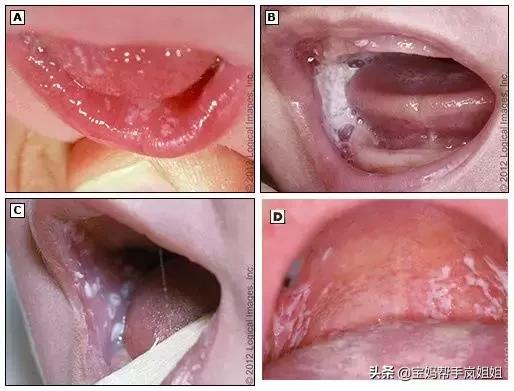 新生宝宝长鹅口疮怎么办,治疗鹅口疮常见药物