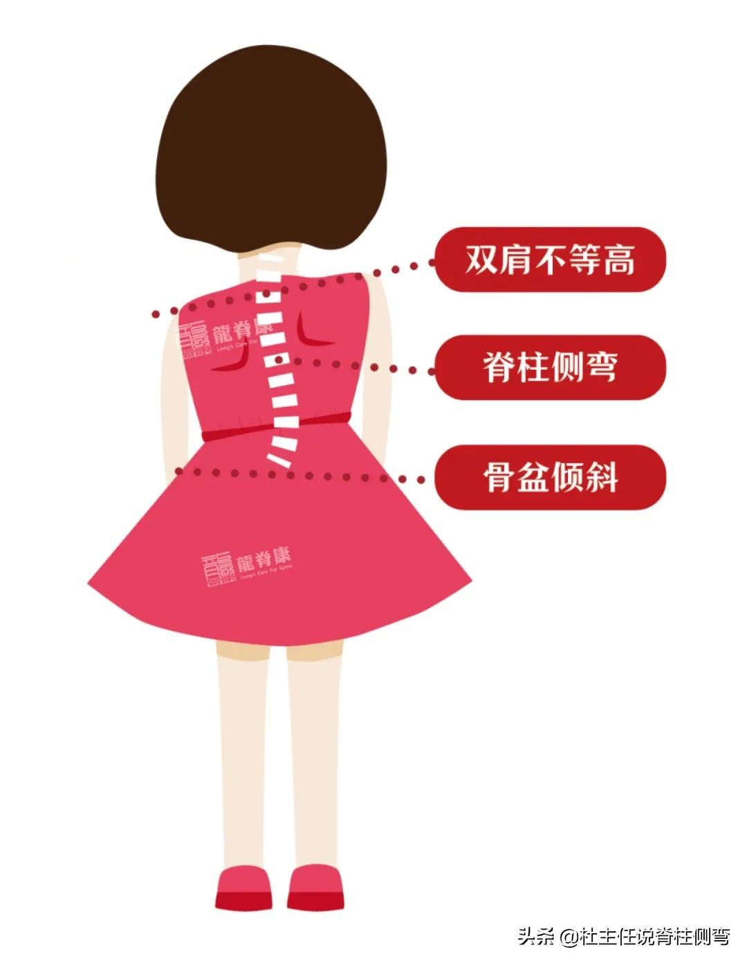 长短腿造成脊柱侧弯怎么治疗,脊柱侧弯长短腿怎么锻炼矫正视频