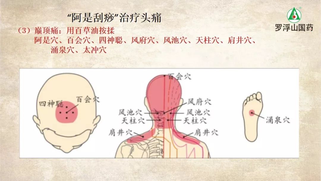 头痛刮痧后就不痛了是什么原因,感冒头痛刮痧快速缓解