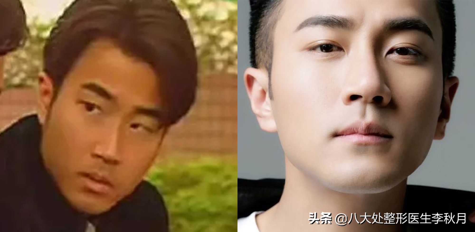 双眼皮刚做完很好看越恢复越难看,双眼皮做完感觉自己睁眼睛不自然