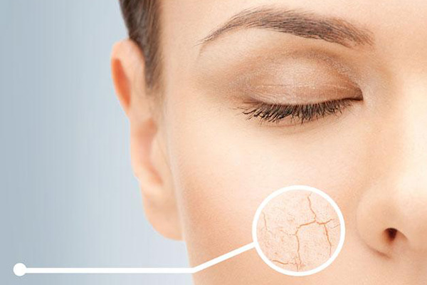 脸上过敏发红起皮干燥怎么补水,皮肤过敏干燥起皮怎么补水最快