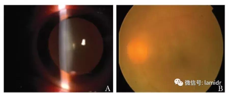hiv感染症状及表现会口干吗,hiv的症状有眼睛红吗