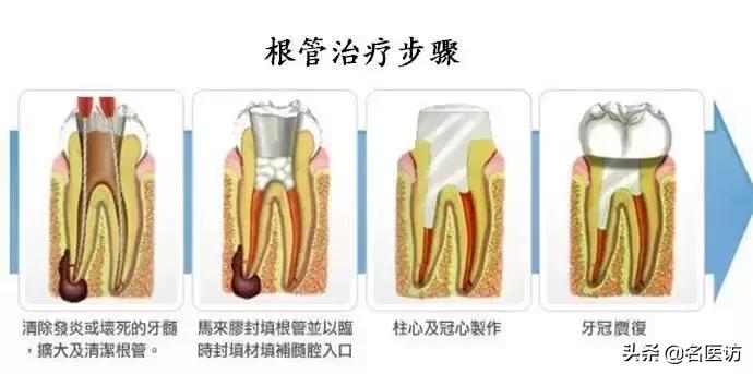 需要根管治疗的牙是什么症状,医生怎么判断是否需要根管治疗