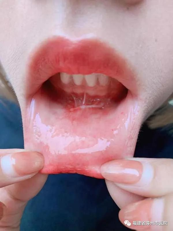 甲状腺癌口腔微创治疗,口腔镜甲状腺癌手术优点