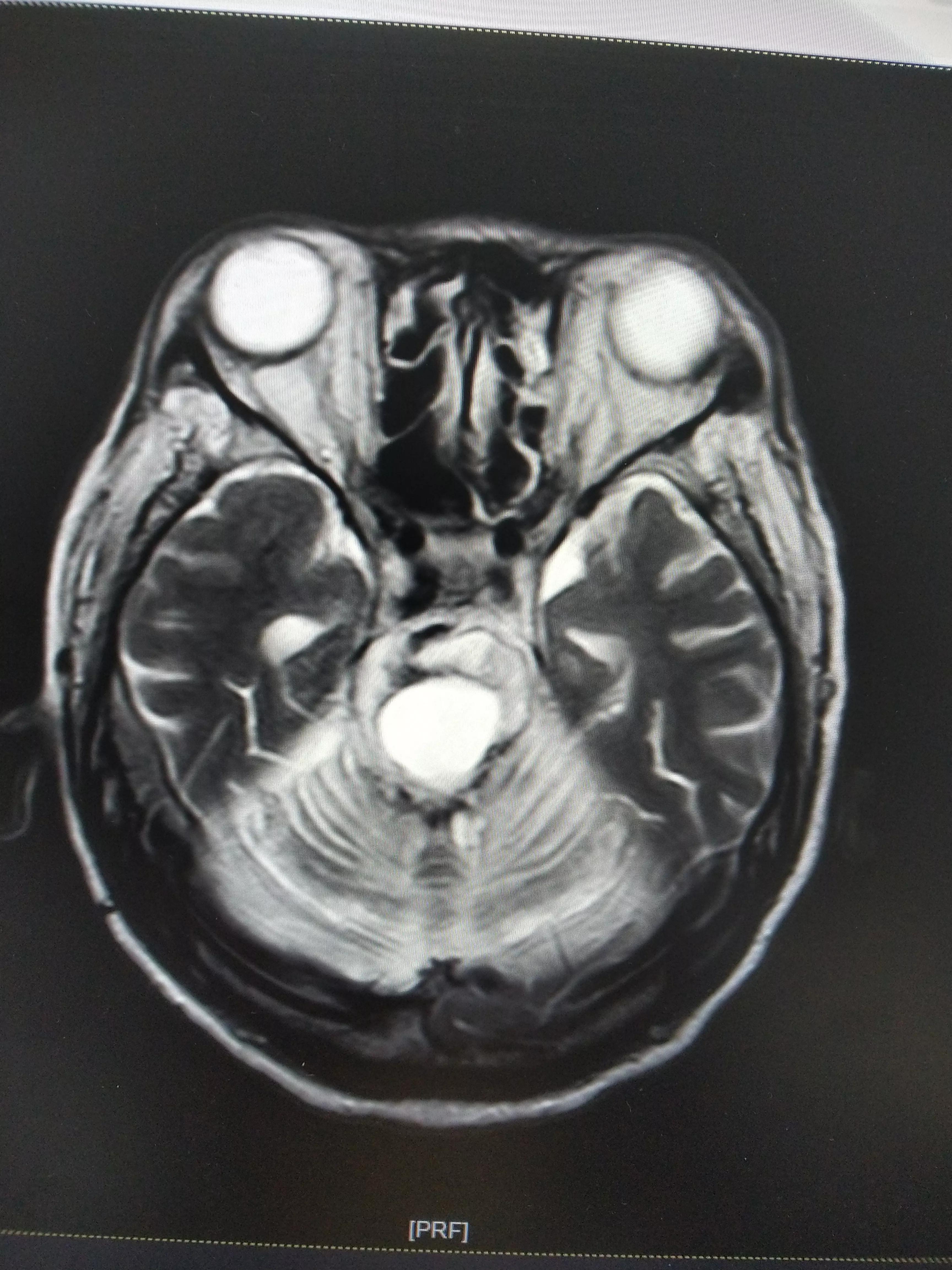 30岁中风,脑中风昏迷不醒的辨证与治疗