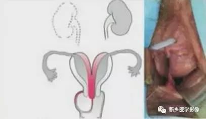 子宫发育异常，应想到的6大类常见畸形