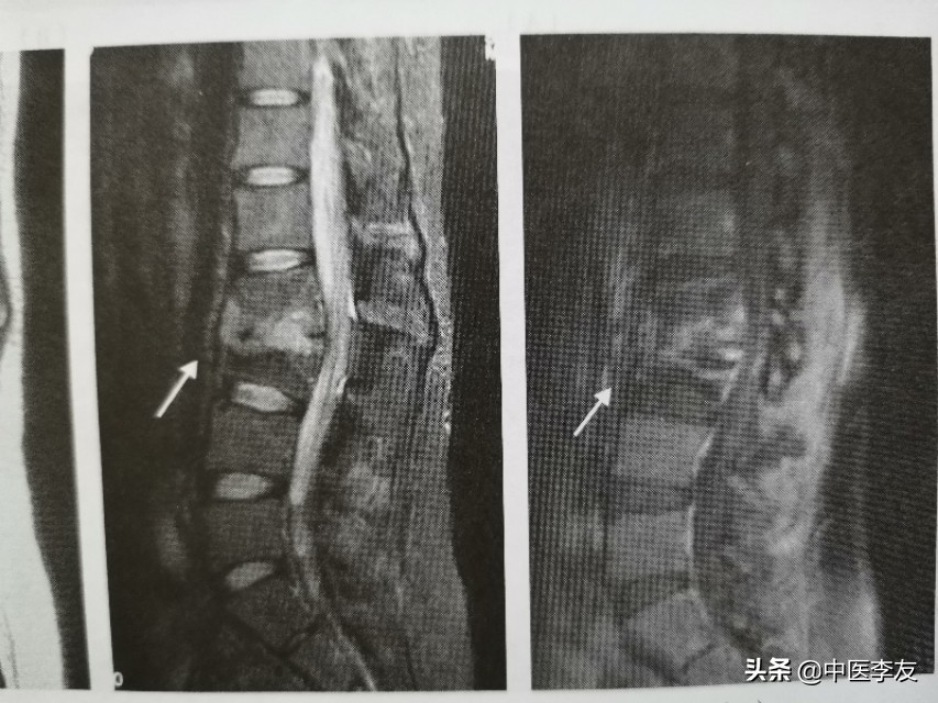 腰椎骨结核治愈后出现腰疼,脊柱结核腰痛怎么治