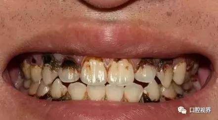 医生,我是癌症患者,从鬼门关走出后,我的牙怎么全蛀了?