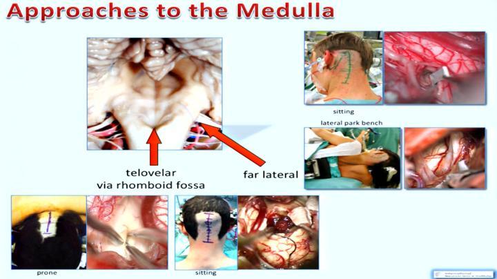 脑干海绵状血管瘤开颅手术,脑干做手术的示意图