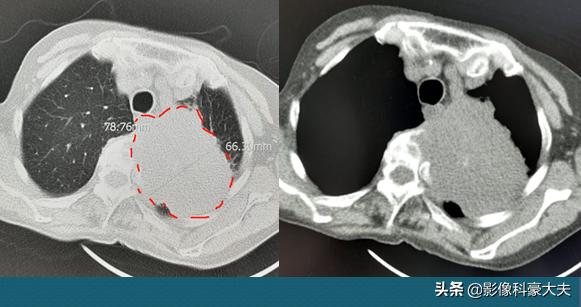 肺癌晚期脑转移用靶向药能活多久,肺癌晚期靶向治疗一般能活多少年